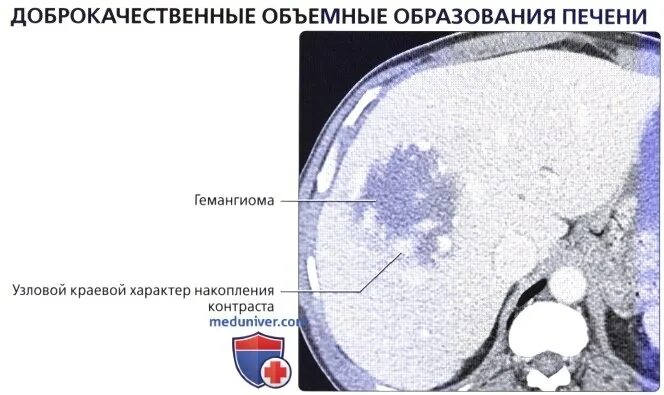 Гемангиома печени на кт с контрастом. Кавернозная гемангиома печени кт. Накопление контраста гемангиомой печени. Атипичная гемангиома печени на кт. Гиперваскулярное образование печени