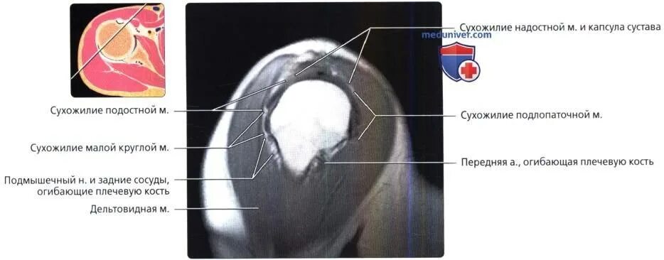 Повреждение сухожилия подлопаточной мышцы. Повреждение надостной мышцы плечевого сустава на мрт. Тендинопатия надостной мышцы плечевого сустава. Тендинита сухожилия надостной мышцы. Тендиноз сухожилия надостной мышцы мрт.