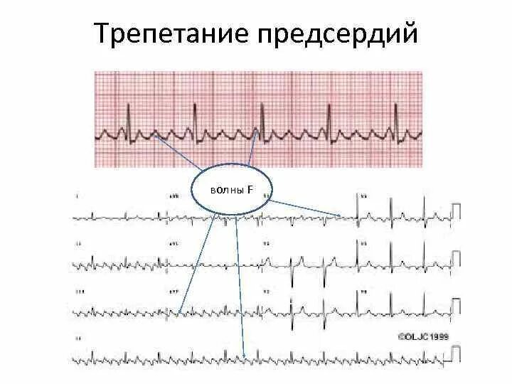 Волны фибрилляции. Трепетание предсердий волны f. фибрилляция предсердий волны ф. волны f при трепетании предсердий. трепетание предсердий 3:1.