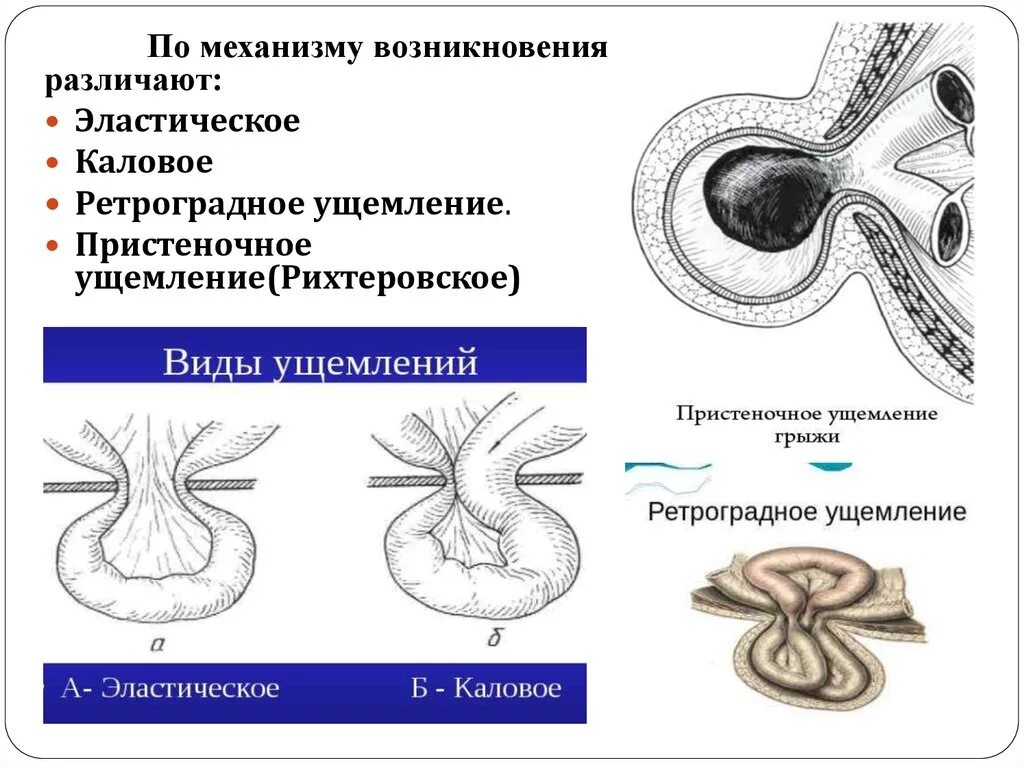 Ущемленная брюшной грыжа. Ущемленная паховая грыжа классификация. Ущемленная паховая грыжа механизмы ущемления. Пристеночное ущемление паховой грыжи. Ущемленная паховая грыжа клиническая картина.