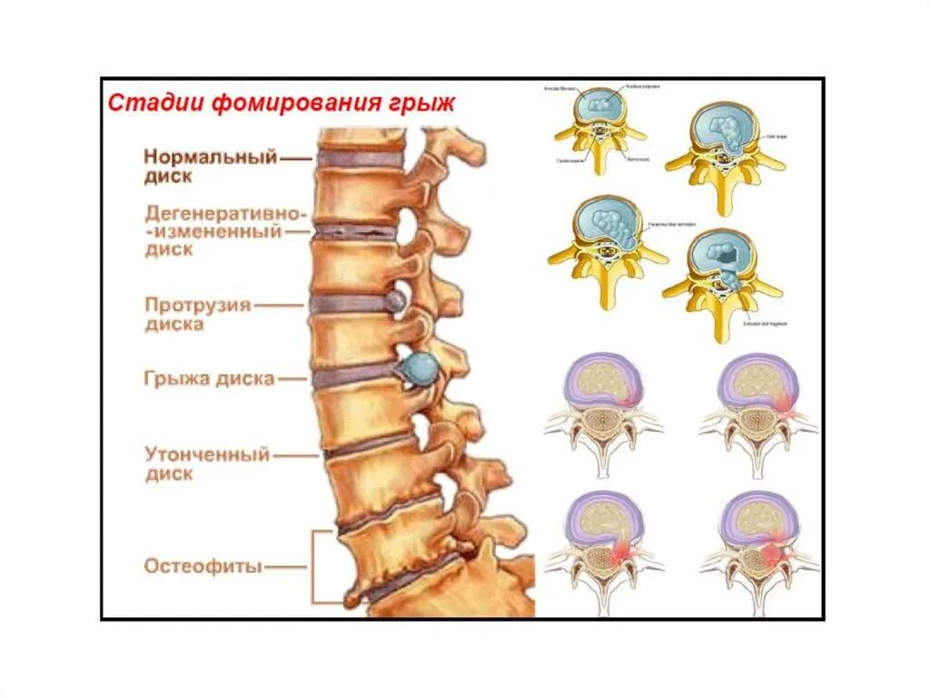 Остеохондроз шейного отдела протрузии. Грыжи позвоночника в поясничном отделе схема. Что такое протрузия дисков позвоночника поясничного отдела. Протрузия диска th2-th3. Строение позвоночника протрузия.