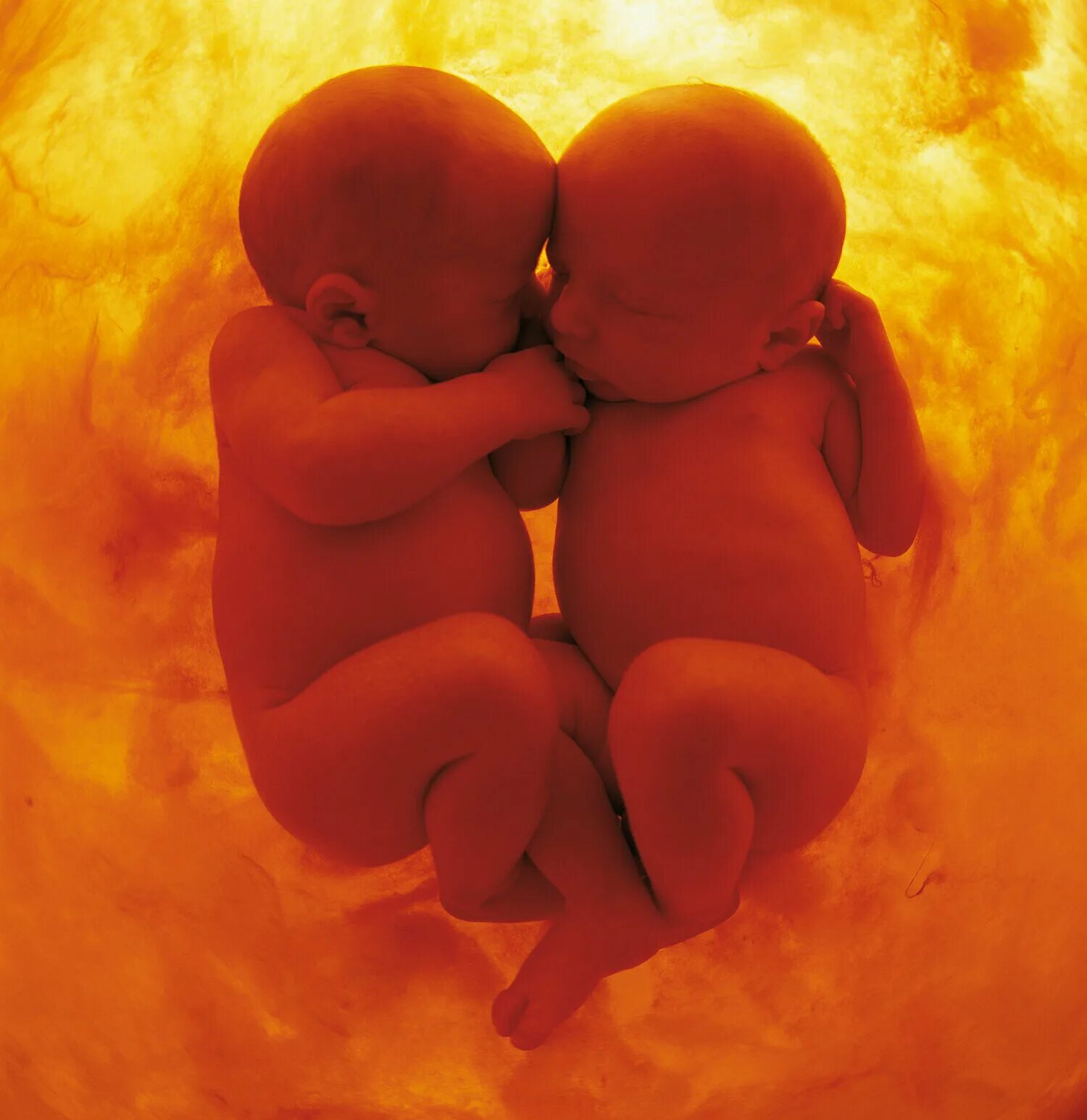 Дети внутри мамы. Многоплодная беременность двойня. Монохориальная моноамниотическая двойня. Многоплодная беременность в утробе. Многоплодная беременность беременность двойней.