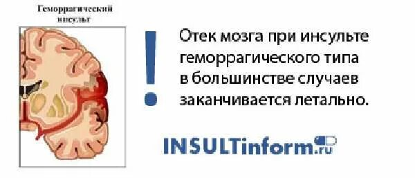 Шансы выжить после инсульта. Отек головного мозга при инсульте ишемическом.