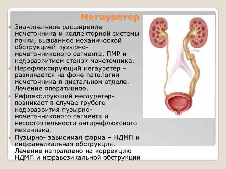 камни в мочевыделительной системе. камни в почках мочеточнике и мочевом пузыре. мочеточник у женщин симптомы. мочекаменная болезнь верхней трети мочеточника. камни в посках симптом.