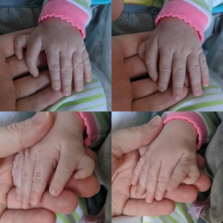 6 пальцев на руках у детей. Дети с шестью пальцами. Пальчики новорожденных на руках.