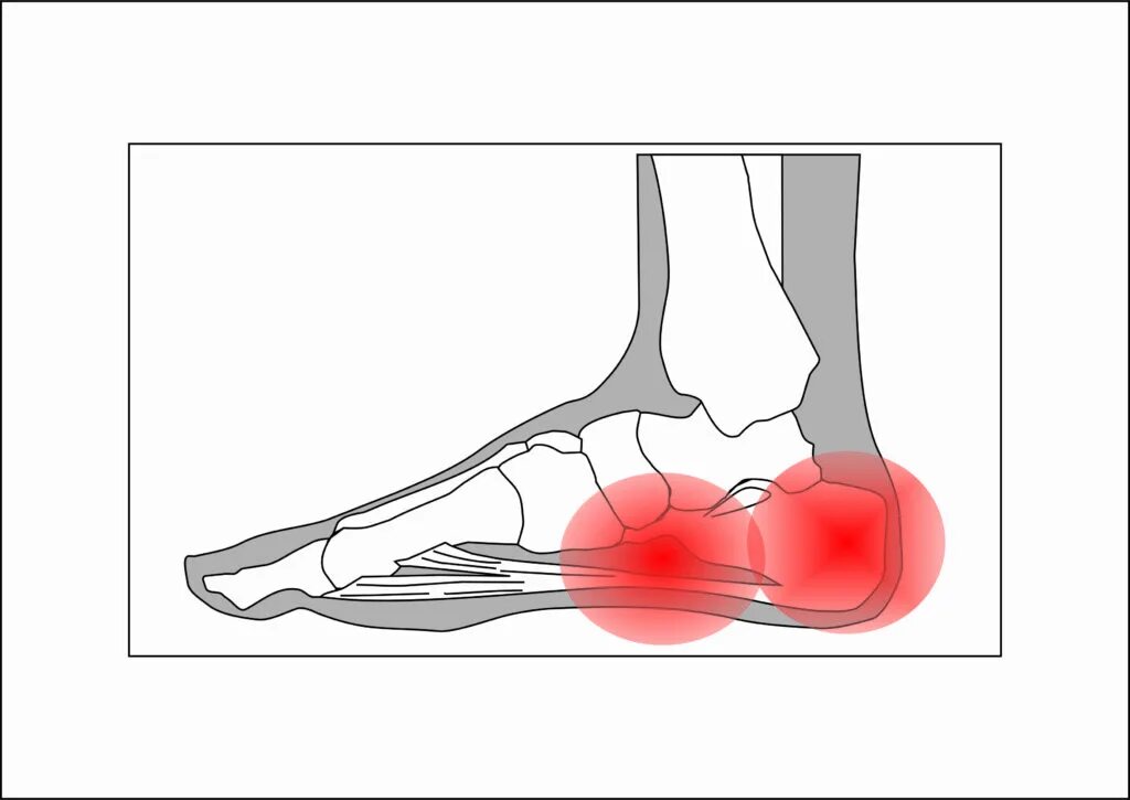 Болят пятки при ходьбе причины у мужчин. Плантарный фасциит (подошвенный фасциит). Плацентарный фасциит стопа. Пяточная шпора и подошвенный фасциит. Подошвенный фасциит свода стопы.