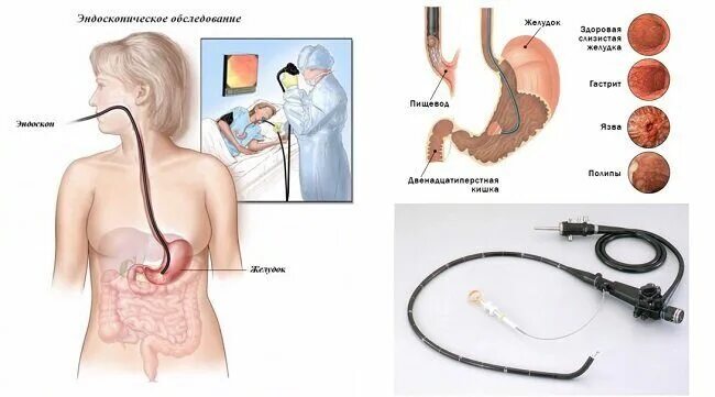 Язвенная болезнь желудка ФГДС. Подготовка к фиброгастроскопии желудка алгоритм. Подготовка пациента к фиброгастродуоденоскопии (ФГДС). Подготовка пациента к ФГДС желудка. Эндоскопии форум