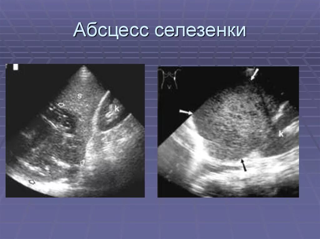 Абсцесс селезенки эхограмма. Цена селезенки