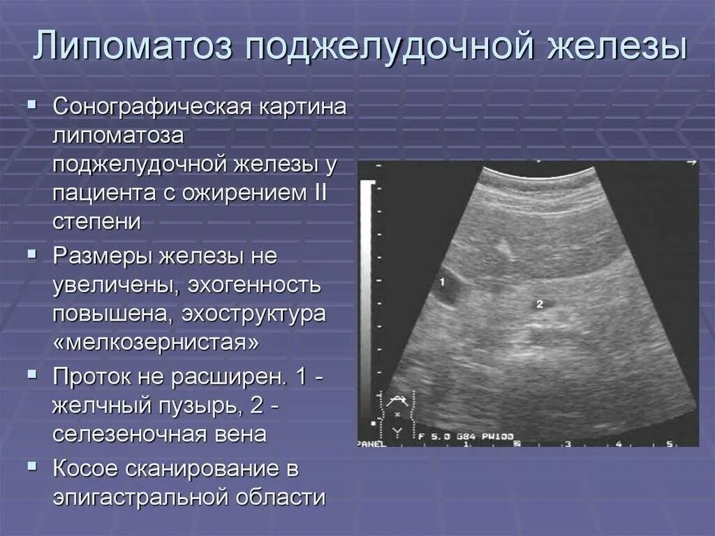 Умеренные изменения печени и поджелудочной железы. Липоматоза поджелудочной железы на УЗИ. Липоматоз поджелудочной железы. Лепатозподжелудочной железы. Липоматоза поджелудочной железы что это такое.