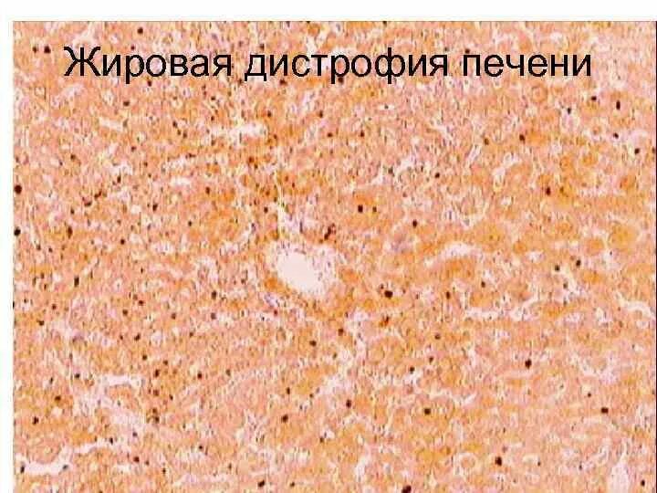 Паренхиматозная зернистая дистрофия печени. Зернистая дистрофия патанатомия. Жировой гепатоз гистология. Препарат жировой дистрофии печени. Жировая инфильтрация печени судан 3.