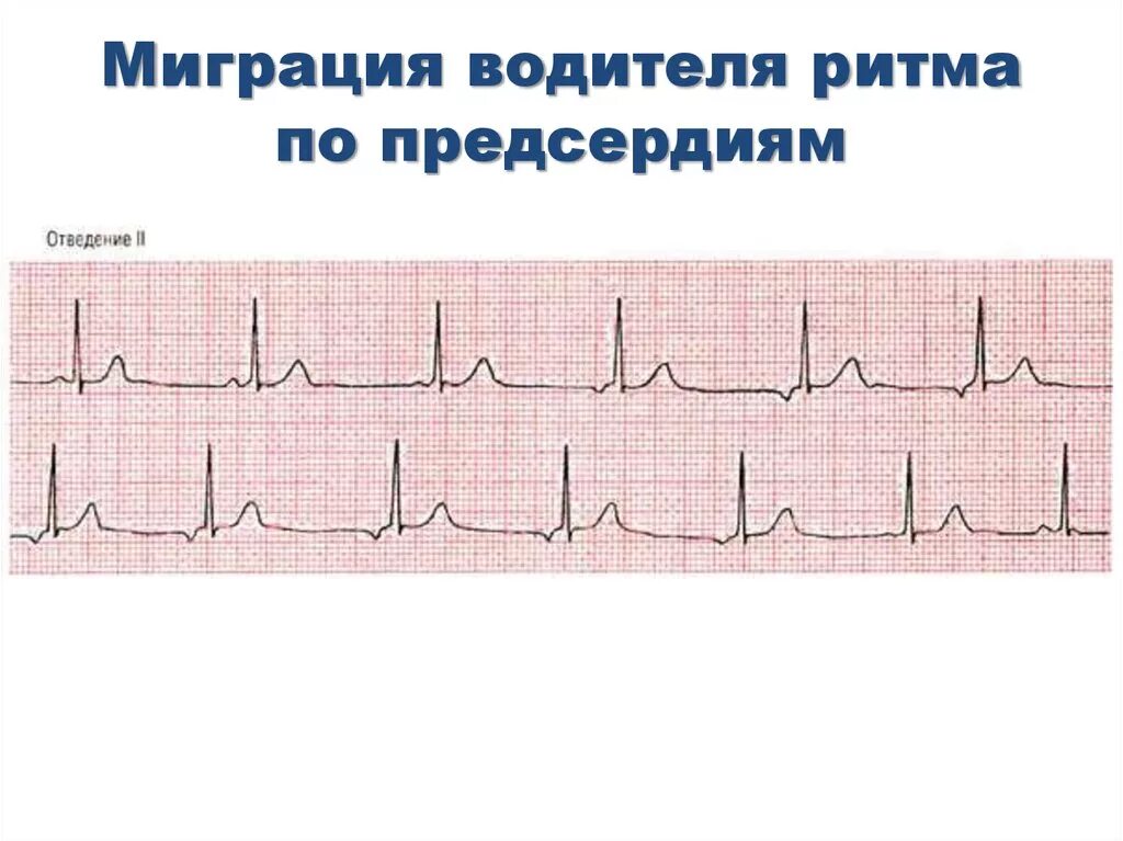 Верхнепредсердный ритм на ЭКГ. Нижнепредсердный ритм на ЭКГ. Эктопический нижнепредсердный ритм на ЭКГ. ЭКГ признаки миграции водителя ритма. Эктопический предсердный ритм что это