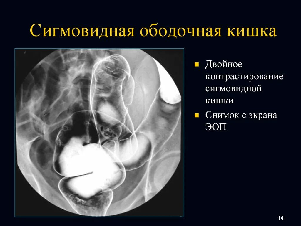 Скелетотопия сигмовидной кишки. Ободочная кишка сигмовидная кишка. Петля сигмовидной кишки. ,Сигмовидная сигмовидная кишка. Удлинена сигмовидной