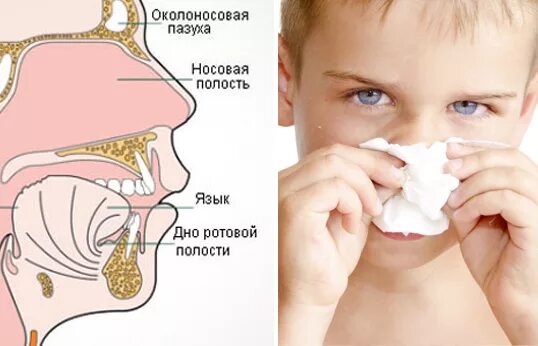 Откуда берется насморк. Аллергический ринит слизь из носа. Слизистая при насморке.