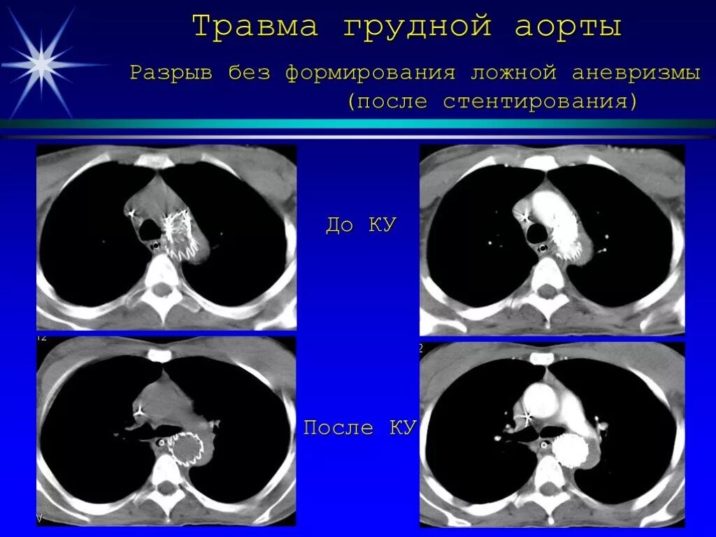 Кт после стентирования