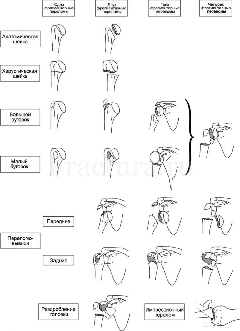 перелом плечевой кости классификация рентген. типичные смещения при переломах диафиза плечевой кости. перелом головки и анатомической шейки плеча. перелом головки плечевой кости классификация рентген. диафизарный перелом плечевой кости классификация.