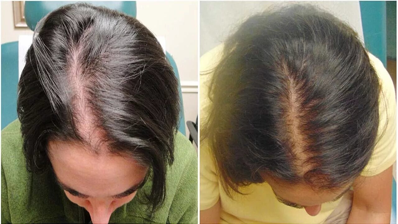 Мезотерапия для волос. Мезотерапия для волос до и после женщины. Выпадение волос до и после. Выпадают волосы после покраски