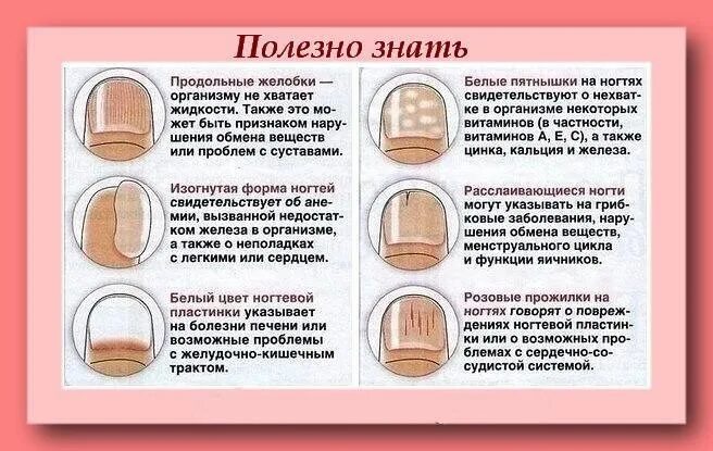 Болезни ногтей на ногах таблица. Определить здоровье по ногтям. Ногти о чем говорят о здоровье человека. О чем говорят ногти. Заболевания по ногтям рук.