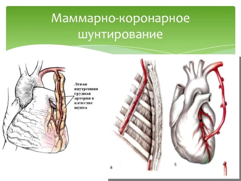 Коронарное шунтирование. Портокоронарное шунтирование. Коронарное шунтирование сосудов сердца. Аортокоронарное шунтирование шов. Как делают коронарное шунтирование