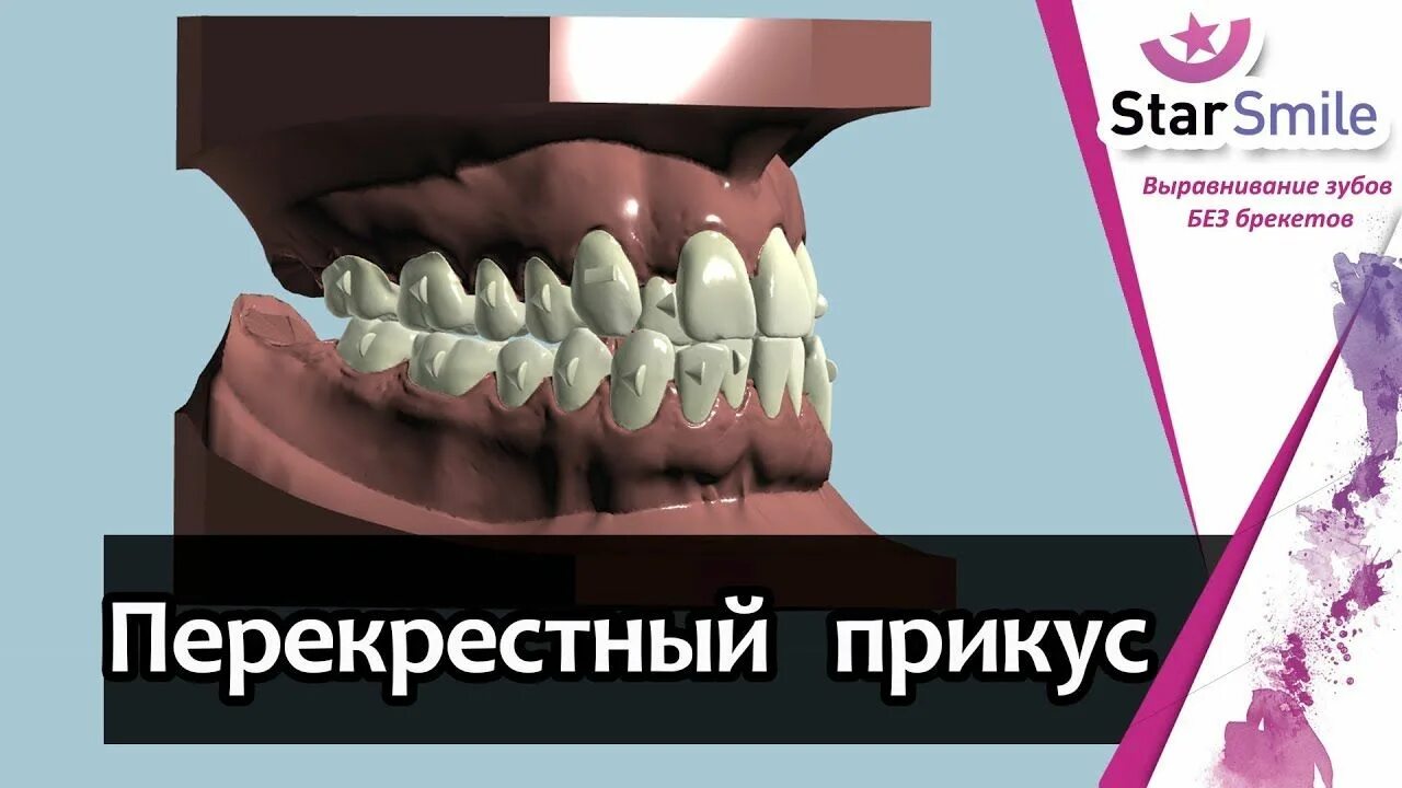 Перекрестные зубы. Перекрёстный прикус эллайнеры. перекрестный прикус элайнеры. элайнеры для выравнивания перекрестного прикуса. элайнеры выравнивают зубы.