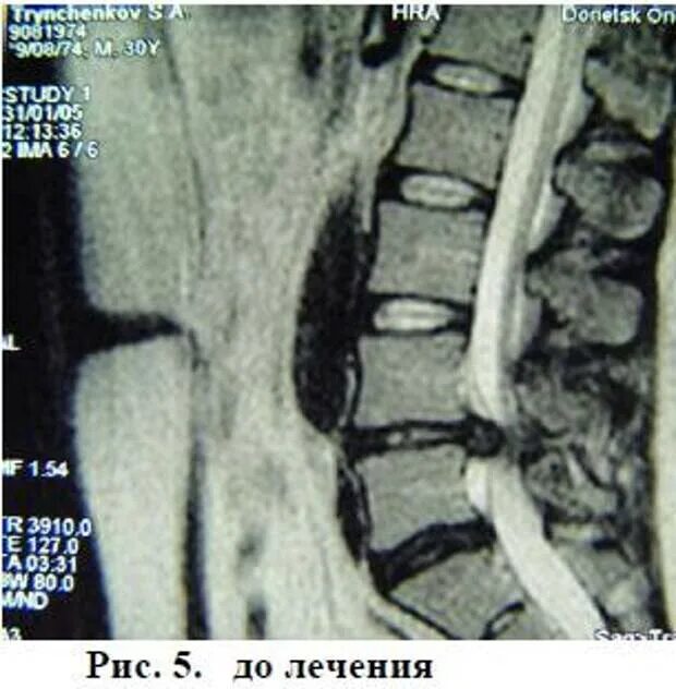 L4 l5 отдел позвоночника протрузия. Секвестрированная грыжа l5-s1 мрт. Секвестрированная грыжа th12-l1. Грыжа диска l5-s1 с секвестрацией.