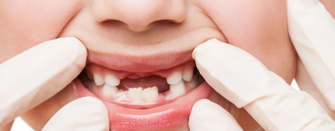 зубы отсутствуют у