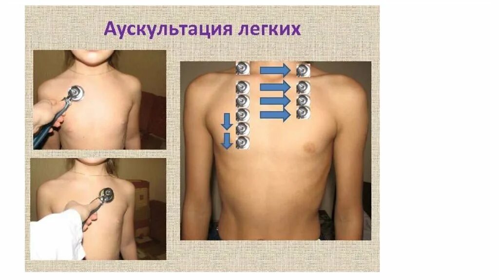 Проведение аускультации легких алгоритм. Аускультация грудной клетки пропедевтика. Точки аускультации лёгких пропедевтика. Проведение аускультации спереди. Схема проведения аускультации легких.