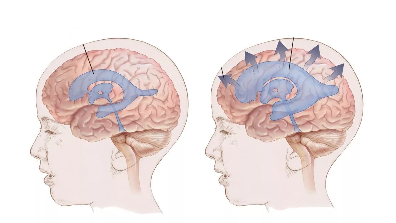 Желудочки головного мозга при гидроцефалии. Гиперсекреторная гидроцефалия. Гипертензионный синдром гидроцефалия;. Церебральная ишемия у новорожденного 2 степени. Нарушение развития головного мозга