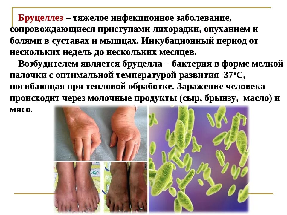 Возбудитель бруцеллеза крс. Бруцеллез (мальтийская лихорадка). Бруцеллез симптомы у животных. Краткая характеристика болезни бруцеллез. Мальтийская лихорадка у человека симптомы.