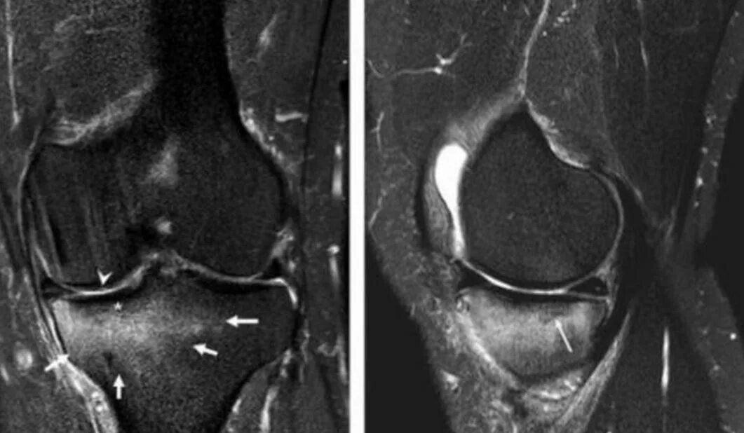 Асептический некроз мыщелков. Рассекающий остеохондрит коленного сустава мрт. Асептический некроз медиального мыщелка. Асептический некроз коленного сустава мрт. Импрессионный перелом колена мрт.