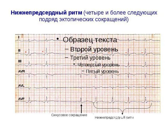ЭКГ заключение нижнепредсердный ритм. Нижнепредсердный ритм на ЭКГ. ЭКГ при нижнепредсердном ритме. Нижнепредсердный ритм ЭКГ критерии. Эктопический предсердный ритм что это