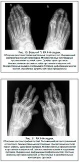 Ревматоидный артрит начальная стадия