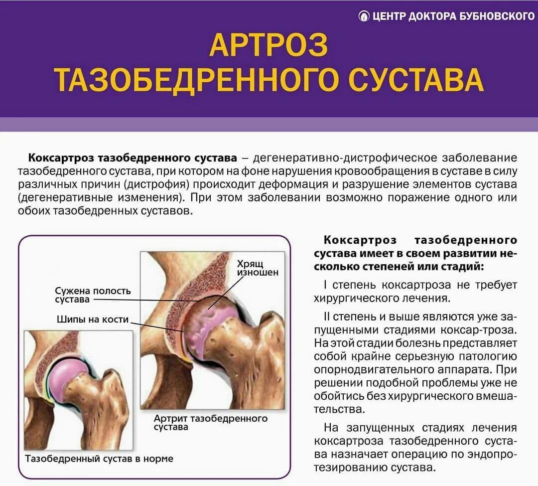 Деформирующий остеоартроз тазобедренного сустава II степени. Заболевание артроз тазобедренного сустава. Артрит артроз тазобедренного сустава.