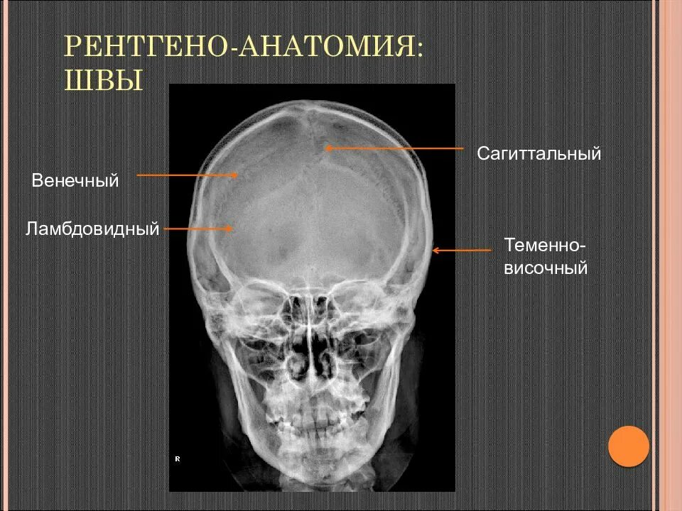 Сотрясение кости. Швы черепа анатомия рентген. Венечный Сагиттальный ламбдовидный шов. Кости черепа на кт.