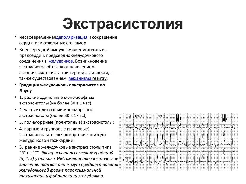 Сколько экстрасистол норма