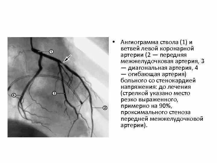 Сосуды сердца схема коронарография. Коронарография стеноз ствола. Ветвь тупого края огибающей артерии. Анатомия коронарных артерий коронарография.