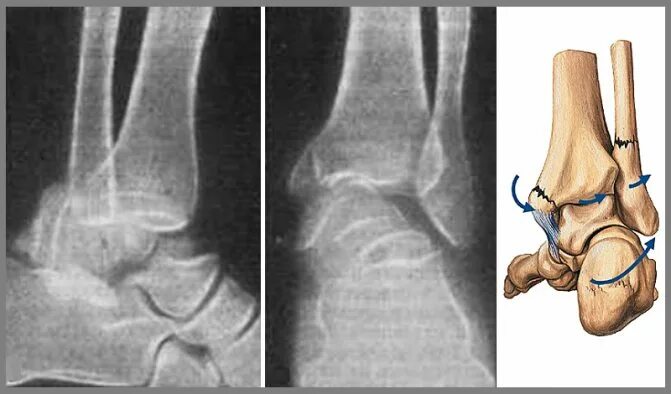 Перелом лодыжки форум вумен. Перелом лодыжки трехлодыжечный перелом. Чрезсиндесмозный перелом лодыжки. Аддукционный перелом лодыжки. Краевой оскольчатый перелом лодыжки.