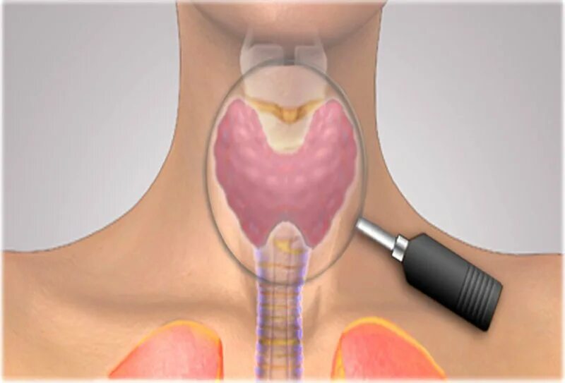 Почему образуются узлы. Узел щитовидной железы 33.7. Доброкачественный узел щитовидной.