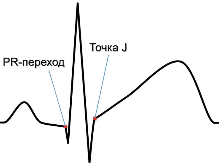 Элевация сегмента St на ЭКГ. Точка j на ЭКГ. Точка j и i на ЭКГ. Точка j на ЭКГ определение. Точка 1.0 старая версия