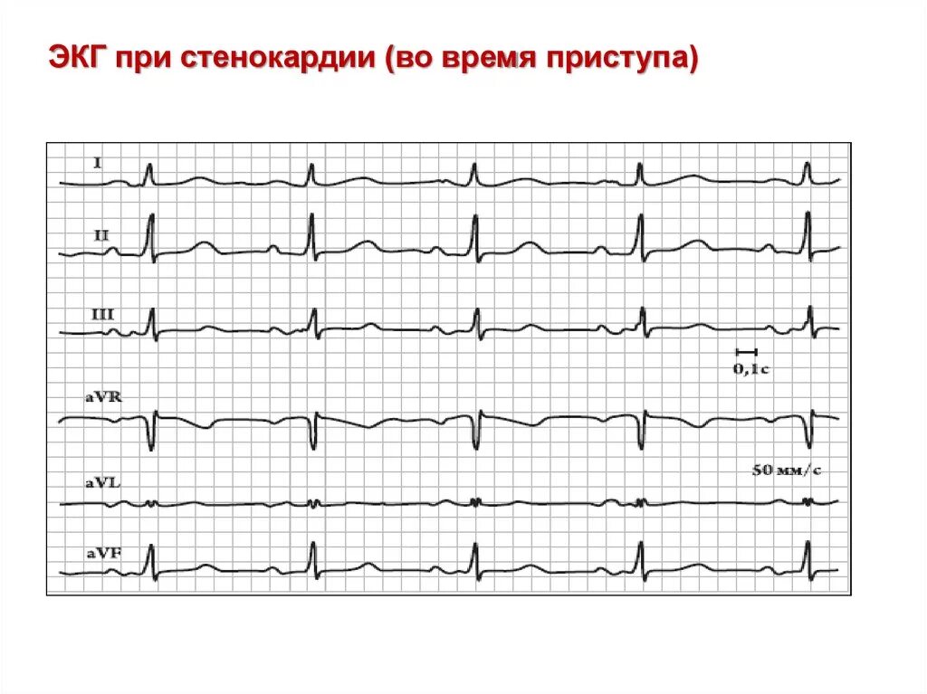 Ишемия боковой стенки. Стабильная стенокардия ЭКГ. ЭКГ ИБС стабильная стенокардия напряжения. ЭКГ при стабильной стенокардии напряжения. ЭКГ признаки стабильной стенокардии.