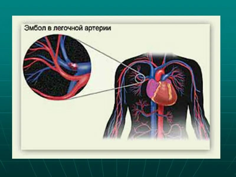 Тромб и эмбол. Тромбоэмболия легочной артерии. тромб в легочной артерии.