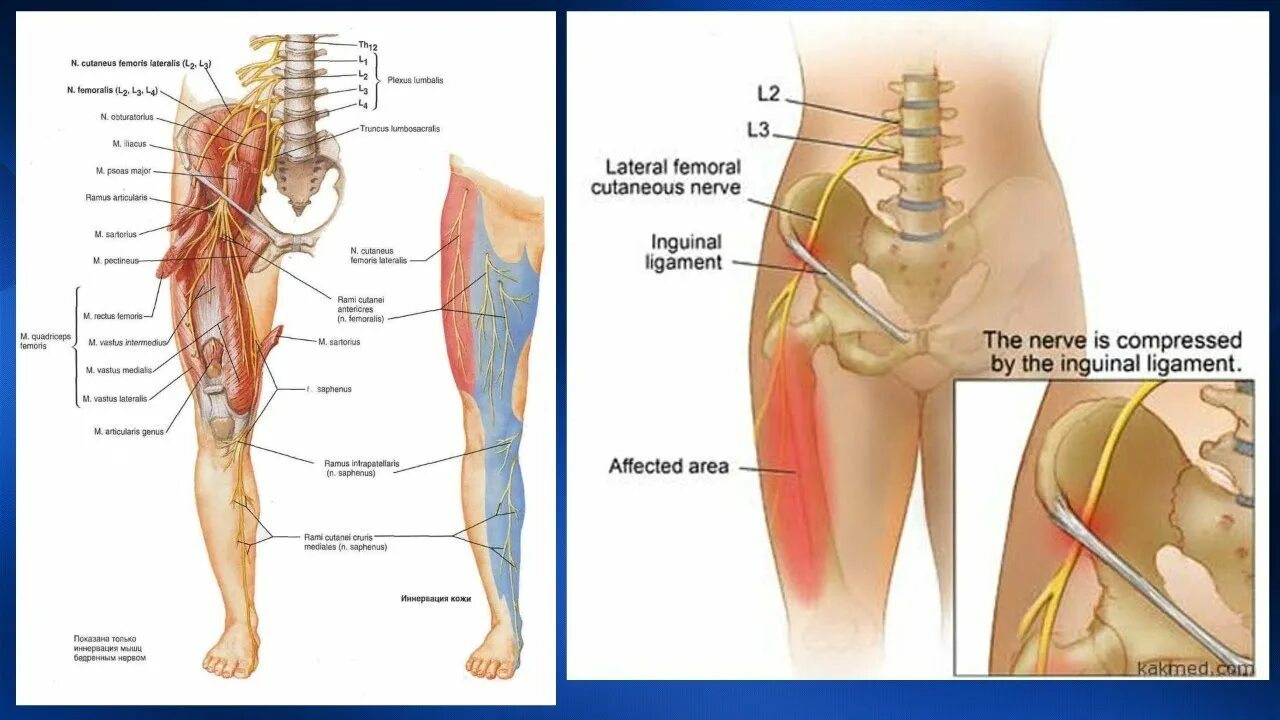 Невропатия наружная бедра. Бедренный нерв и седалищный нерв. Нейропатия бедренного нерва. Невропатия латерального кожного нерва бедра. Невропатия бедренного нерва анатомия.