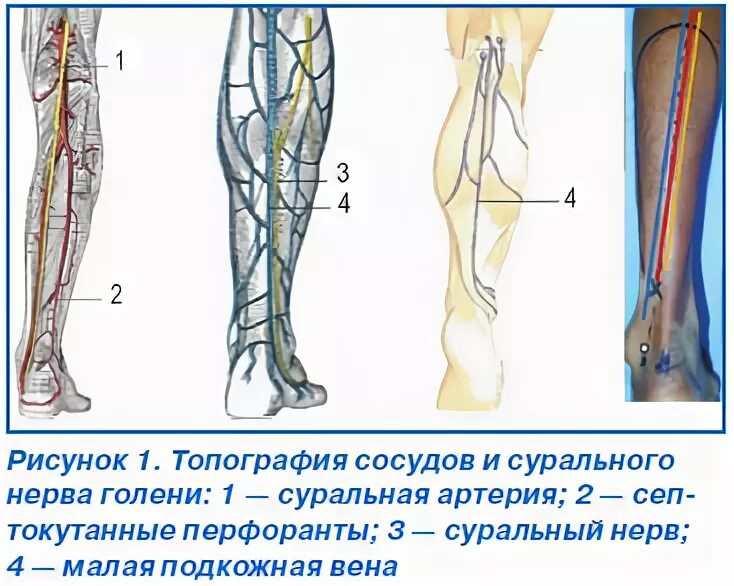 Суральных вен голени