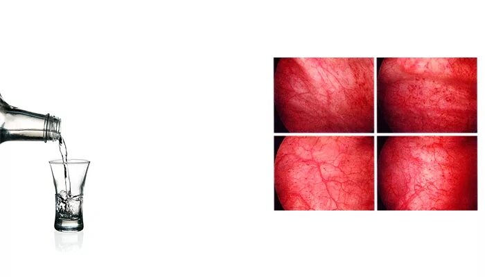 Бутылка воды при цистите. Алкоголь при цистите.