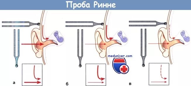 Камертональные пробы Вебера и Ринне. Проба Вебера Ринне Швабаха. Исследование слуха камертонами-пробы Ринне и Вебера. Исследование воздушной проводимости камертонами.