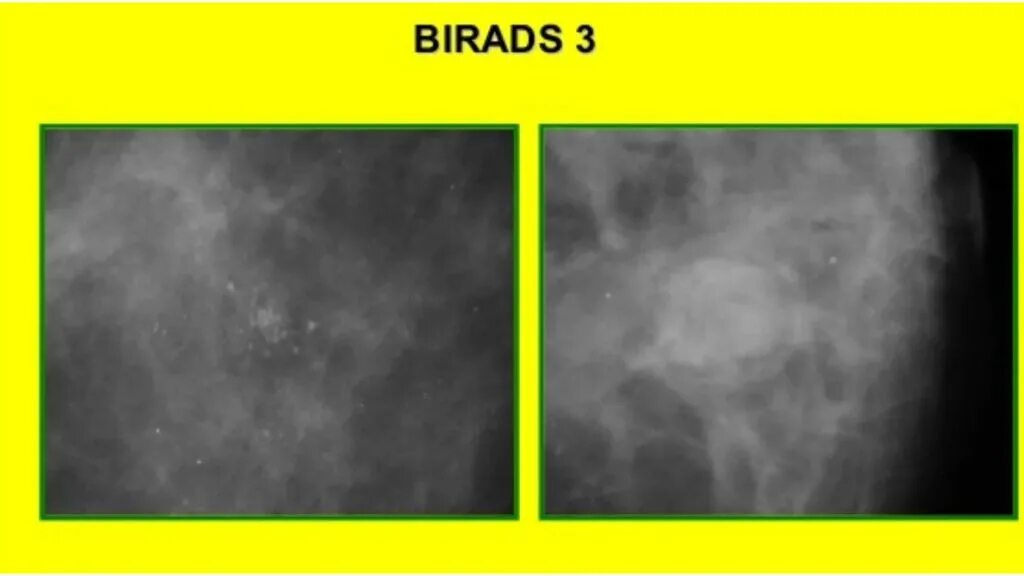 УЗИ молочных желез bi rads. Bi rads молочная железа. Bi rads маммография. Bi-rads 3 молочной железы маммограмма. Категория bi rads 2 молочных желез