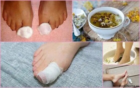 Как выглядит запущенный грибок на ногах Really Thick Baby Toenail From Athlete's Foot Outlet