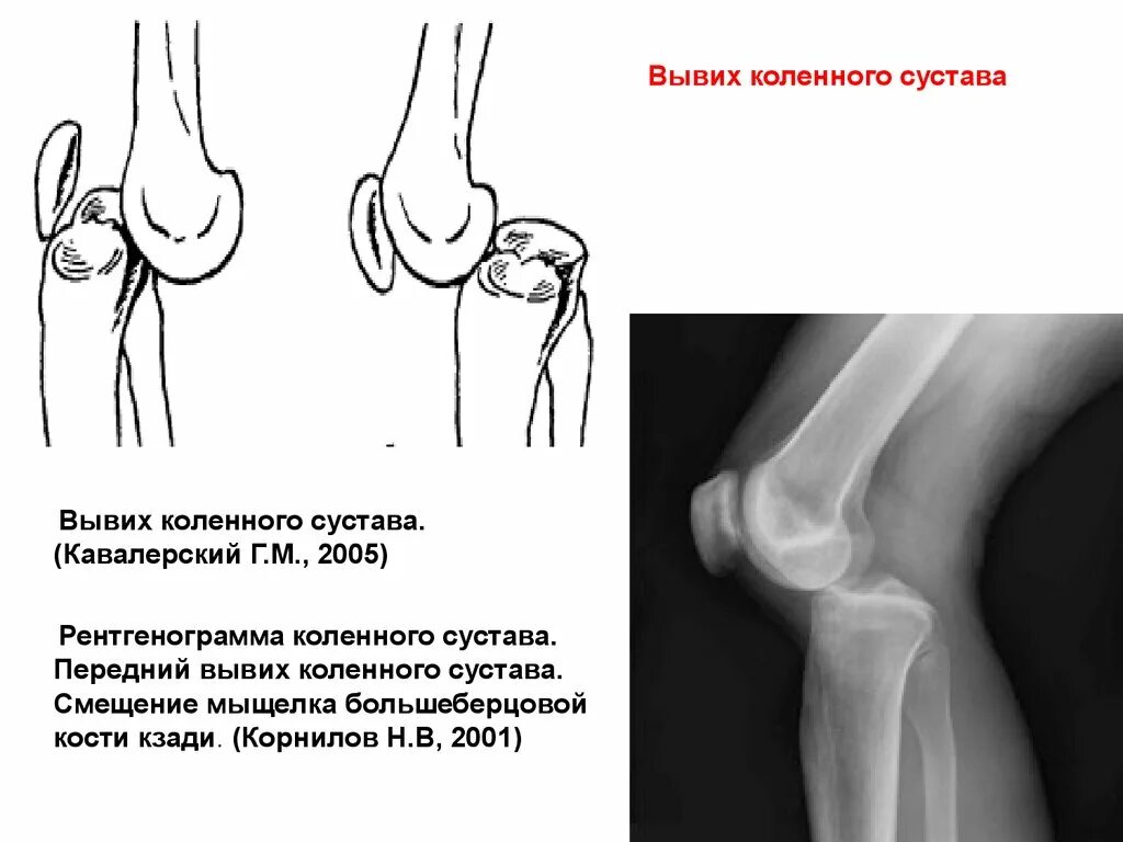 Вывих коленного сустава рентген. Вывих чашечки коленного сустава рентген. Рентген колена сустава вывих. Передний вывих большеберцовой кости.