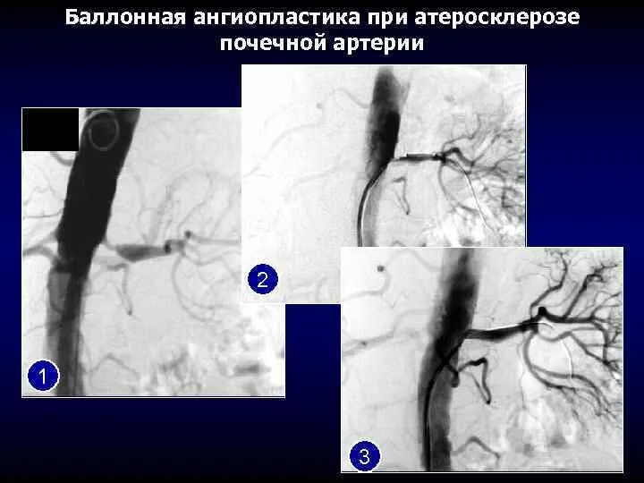 Фибромышечная дисплазия почечных артерий. Ангиопластика почечных артерий. Баллонная ангиопластика почечной артерии. Баллонная дилатация почечной артерии. Тромбоз почечной артерии