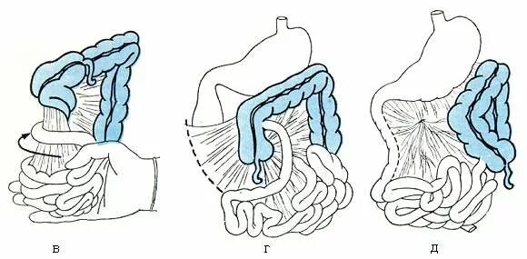 Симптомы операция кишечнике. Заворот кишок операция. Заворот кишечника операция. Мальротация кишечника.