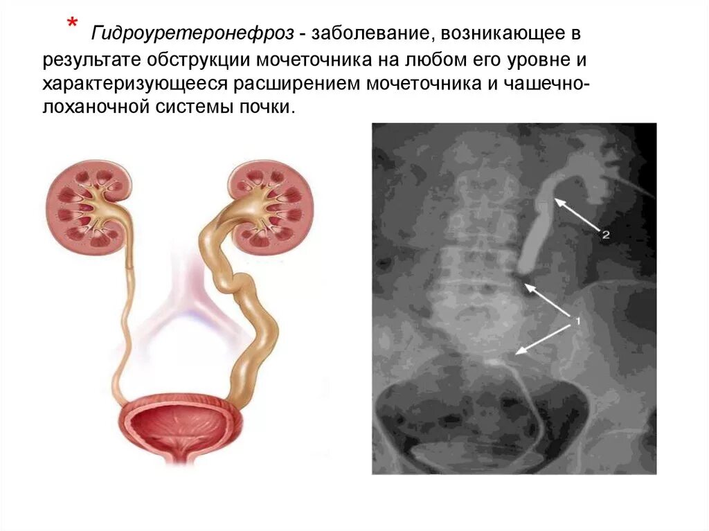 Мочекаменная болезнь камень лоханки левой почки. Мочекаменная болезнь. Обструкция мочеточника. Синдром обтурации мочевыделительной системы. Обструкция нижних мочевых путей.